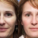 41 Year Old Female Treated For Photoaging With Pixel Laser