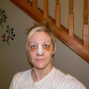 Day 4 Post Op. bruises are slowly getting lighter =)