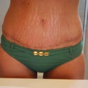 3 weeks - These bikini bottoms barely cover my scar.  I pulled them down some to get a pic of the incision.
