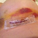 Bruising Day 5