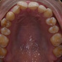 My top teeth before Invisalign and the extraction.