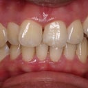 A front view of my teeth before Invisalign