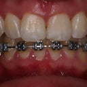 A front view of my teeth during braces!  You can see the progress on the top and my attachments.