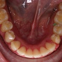 My bottom teeth after braces and Invisalign!  I am getting more trays for the bottom, but if this had been the end of my treatment, I would still be happy.