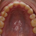 My top arch!  I am about to enter refinement, but again, if this was the end of my treatment, I would be thrilled.