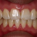 An almost finished product!  You may notice part of my gum is puffy on the right hand side.  This was because I had just gotten my braces off and the tissue was irritated.