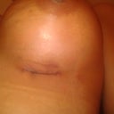 Incision on left breast, postop day 2