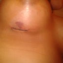 Incision on right breast, postop day 2