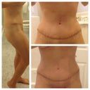 12 Days PO. Swollen in the upper abs.