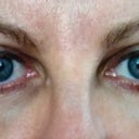 3 weeks: Bruise under right eye is almost gone though there is still a dark shadow underneath.