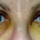 Day 5 - under eye swelling significantly reduced. Lots of yellowing.