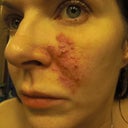 months later, as my body tried to get rid of the product, huge pustules formed.  It was embarrassing, and impossible to cover up.