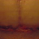 2 Weeks and wound thats opened up due to an infection (sorry for the graphic pic)