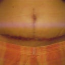 4 Weeks Post op front view