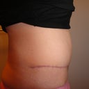 3 months - The fat above my bb is that nasty visceral fat that only losing weight and exercise will get rid of.....I WILL do it!