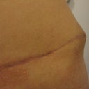 3 months - As the swelling goes down, this is more apparent.  In Sept I will have it removed.