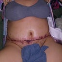 15 pounds total 8lbs removed 6.8 lbs lipo.