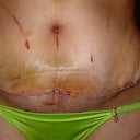 Steri strips off
