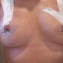 Day 3 from removal of bandage--more white tape trying to pull the nipples up. I have a rash on my skin -i think from all the days being covered up.!