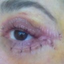 If you look at this picture of the stitches it seems much thicker them any others that I've seen. Has anyone ever seen them like this? Hoping scar won't heal thick but it feels like a big ridge now. :(