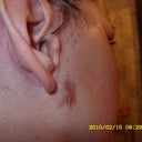 Burn (or whatever it is from) 3 months after