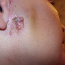 Burn 8 days after 