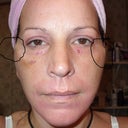 circles show what puckers look like 8 days after