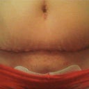 Lots of swelling but the incision looks beautiful and is healing nicely.