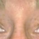 Day 2 - sorta "before" ... I had minimal drooping and was not alarmed (though this is less "wide-eyed" than I usually am.