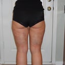 24hrs post op