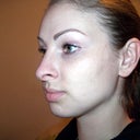 Day before 2nd nose job