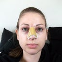Front day after op