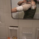 AFTER day 1 right arm