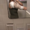 AFTER day 1 left arm(leaking)