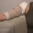 AFTER day 1 left arm