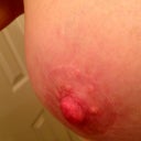 6 month incision close up