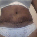 4 wks po close up still some bruising