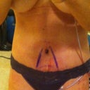 Day 3.  Scar so low it's hidden in my underwear. I didn't think I was that swollen at the time :)