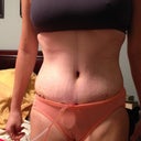 4 Days PO.  VERY pleased with my waist.  Dr. Gervais is a genius!