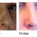 My nostril work is evident, but my nose is super wide still and my tip doesn't have any definition... looking forward to watching it change over the next year!