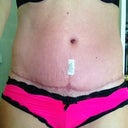 8 weeks po.  The scar is healing. Slowly. But I think it's looking better.