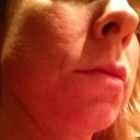 Day 40 after fraxel 1st tx- other 3/4