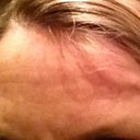 Day 40 after fraxel 1st tx- forehead straight