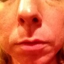 Day 40 after fraxel 1st tx- front view