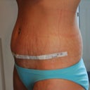 14 days PO right angle view