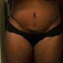 2 wks PO There is a small pucher at the top of my incision, should go away as I continue to heal.
