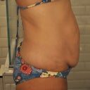 side view day before op