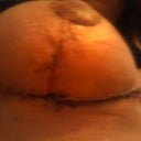 1 week post op right side
