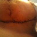 1 week post op left side
