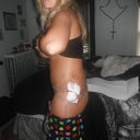 1 Week!!!!! Still quite swollen.